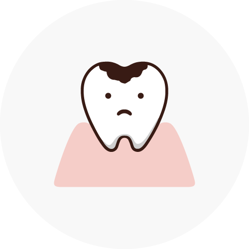 C2（象牙質の虫歯）
