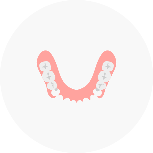 ノンクラスプデンチャー（バネのないタイプ）